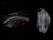 VolPure C reconstruction of the fetal spine